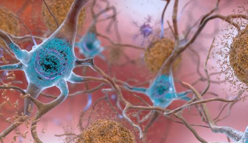 Artwork showing neurons along with the tangles of tau protein and clumps of amyloid-beta plaques that are typically found in the brains of patients with Alzheimer’s disease. Investigating when and how these proteins form might lead to new therapies.