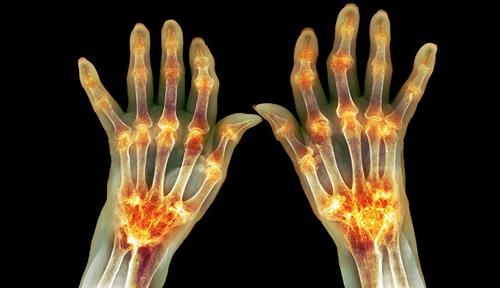 A falsely colored X-ray highlights rheumatoid arthritis in the hands of an 81-year-old woman. 